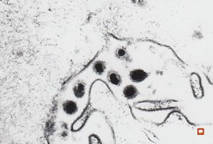 F,65y. | Epstein-Barr virus - hairy leukoplakia of tongue F,65y. | Epstein-Barr virus - hairy leukoplakia of tongue